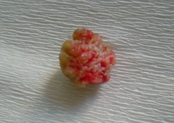 寻常疣患者该吃什么食物