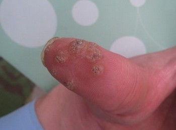 得了寻常疣不能吃什么食物