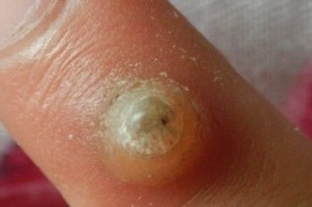 得了寻常疣需注意