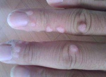 寻常疣的常识病因