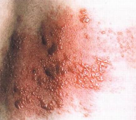 激发带状疱疹的病因有什么