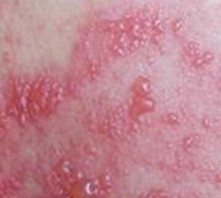 带状疱疹有哪些常见症状