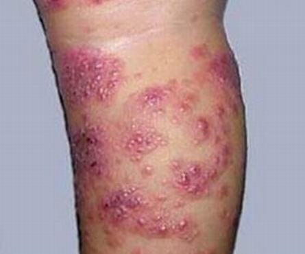 水痘与带状疱疹有什么不同