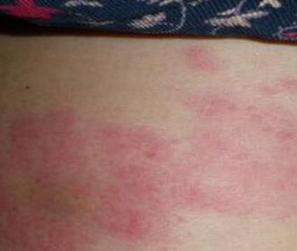 带状疱疹的临床症状有哪些_带状疱疹症状_大成皮肤网
