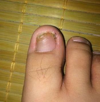 什么是常见甲沟炎的症状