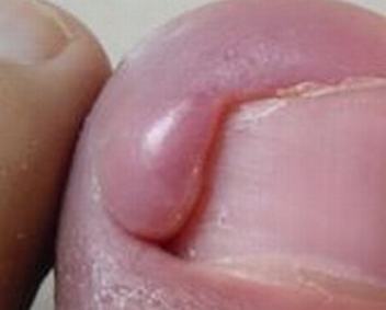 手指甲沟炎有效的治疗的手法