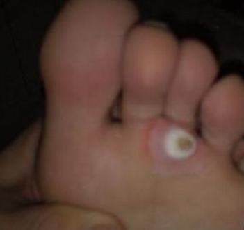 软鸡眼应要如何治疗