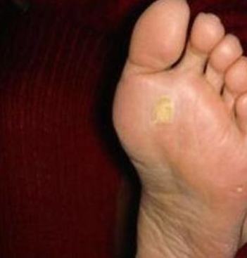 手上长鸡眼怎样呢治疗后复发吗