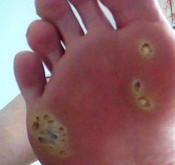 糖尿病患者应该怎样的预防长鸡眼