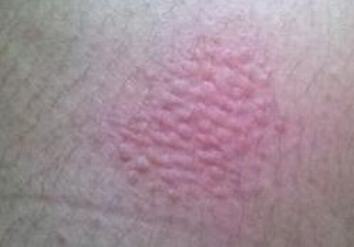 皮肤过敏会有哪些严重危害