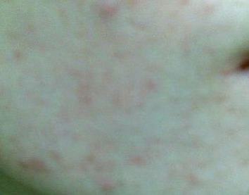皮肤出现红斑是皮肤过敏吗 