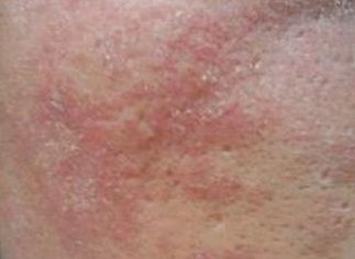 皮肤过敏伤害有什么