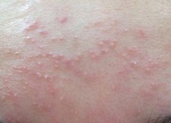 皮肤过敏对人体造成的伤害有什么