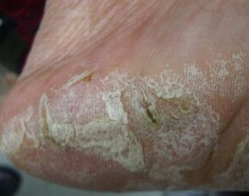 手足癣是手癣和足癣的合称;它是由丝状的致病真菌引起的,其中足癣