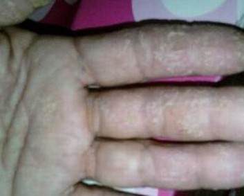 治疗手足癣要如何做