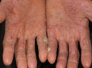 治疗手足癣偏方