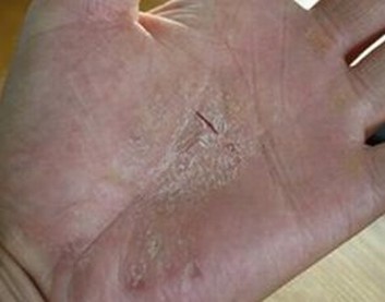 治疗手足癣好的措施