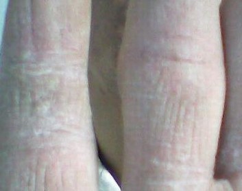 怎样护理水疱型手足癣