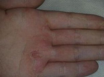 夏季怎样的预防手足癣传染给家人朋友 