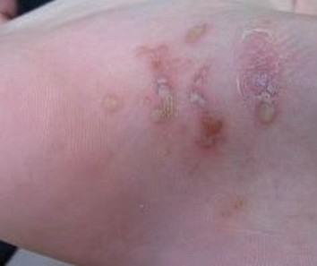 糖尿病患者要预防手足癣