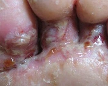 水泡型手足癣怎么治疗