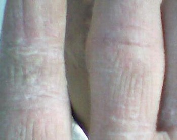 手足癣的症状表现以及治疗的手法