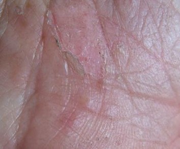 手足癣有哪些明显症状