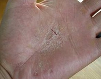 手足癣怎样预防