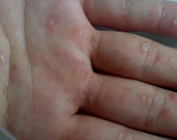 手足癣症状是哪些