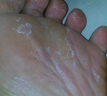 手足癣主要症状有什么