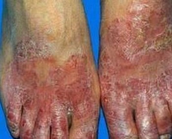 手足癣的症状有哪些 