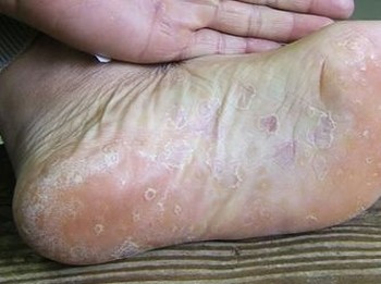 手足癣的主要症状是什么