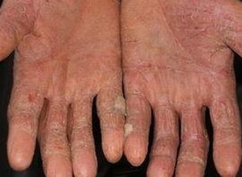 手足癣复发对健康带来哪些严重的危害 