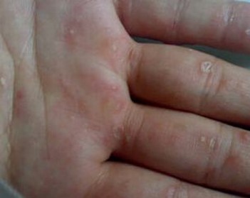 手足癣护理是要注意哪些