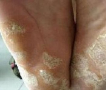 手足癣患者生活中需要注意什么