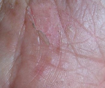 手足癣疾病的病因及症状类型 