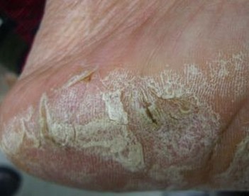 手足癣疾病该怎么进行预防 皮肤病医院怎么样