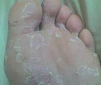 手足癣的危害你知多少