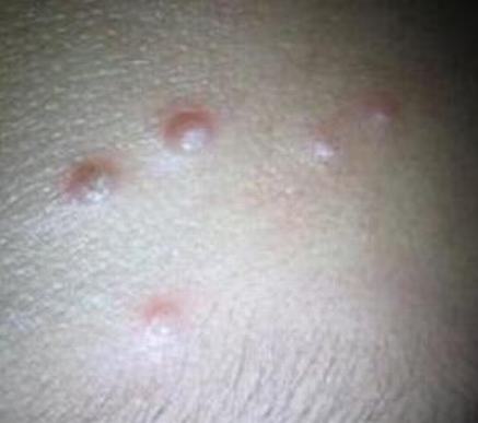 传染性软疣一定是性病吗