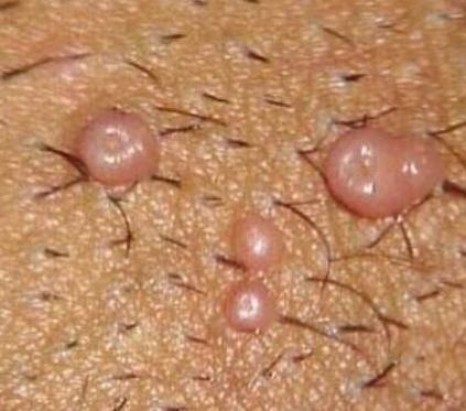 传染性软疣症状体现有什么