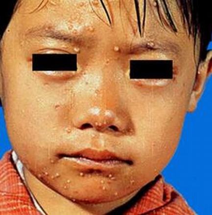 生活中要如何护理传染性软疣