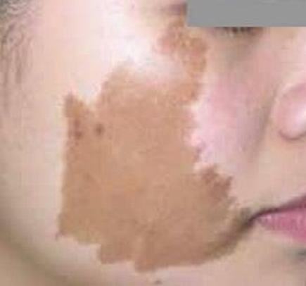 激光治疗咖啡斑疗效怎样