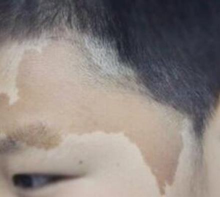 咖啡斑不治会癌变吗