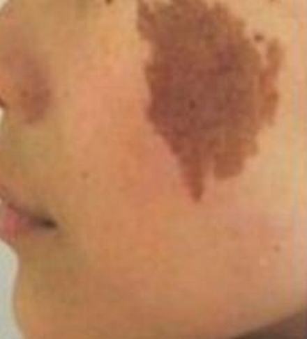 咖啡斑的表现特点及病理显示