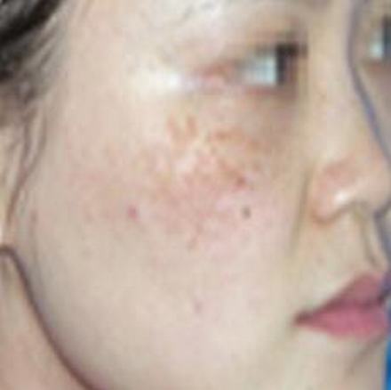 咖啡斑的发病的原因