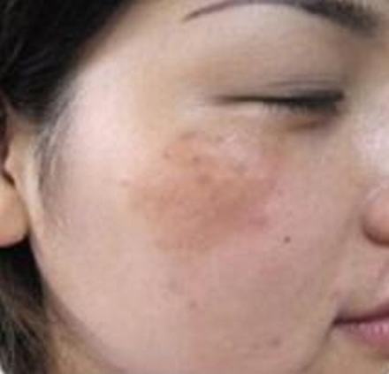 咖啡斑的发病特点有哪些