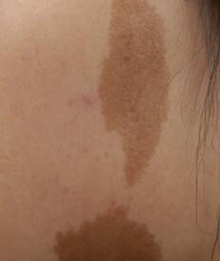咖啡斑的两种皮肤科表现