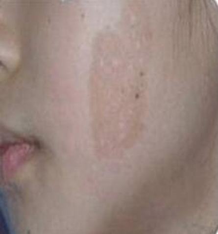 咖啡斑的临床症状有什么