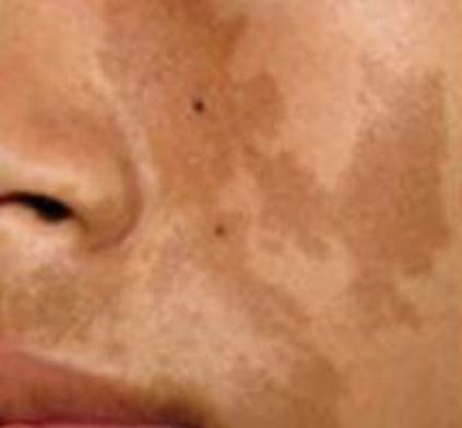 咖啡斑患者的诊断及与皮肤花斑样的比较