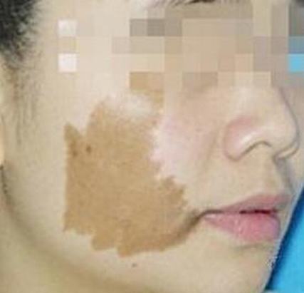 咖啡斑激光几次才能好